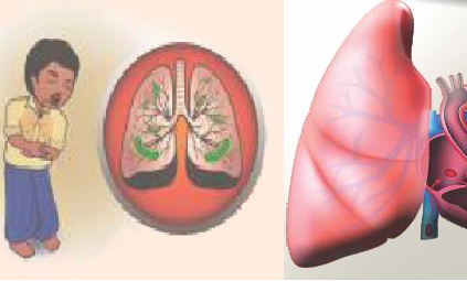 tuberculosis-paru