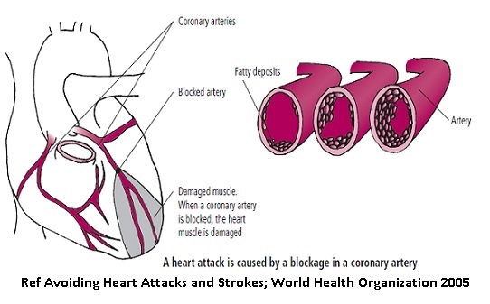 Terjadinya mengakibatkan di akan darah penyempitan terjadinya jantung pembuluh daerah Penyempitan Pembuluh